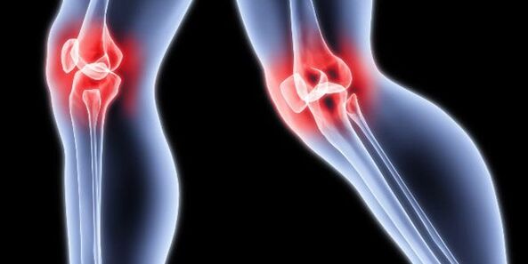 Knee osteoarthritis