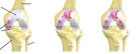 degree of osteoarthritis