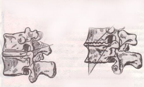 The intervertebral disc is healthy and with lumbar osteochondosis