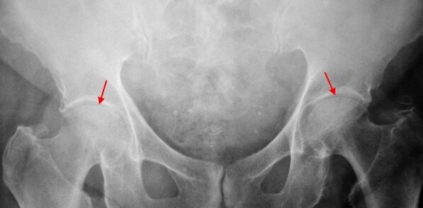 Double -sided coksartrosis