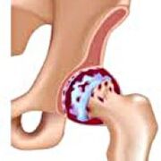 Hip joint articulation