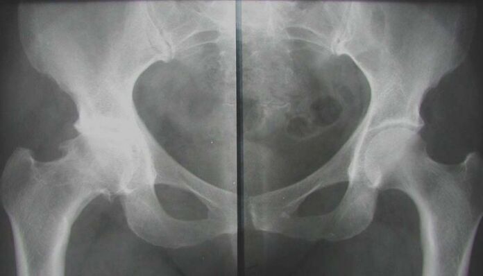 x-ray of affected hip joint with arthrosis